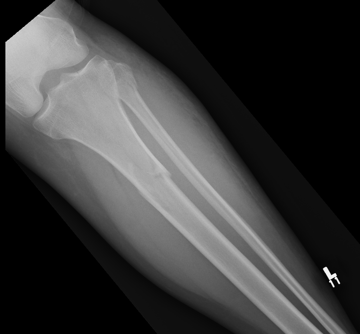 Proximal tibia fracture 1